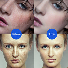 Load image into Gallery viewer, Electric Plasma Jet Pen Freckle Remover Machine Mole Removal Dark Spot Remover Skin Wart Tag Tattoo Remaval Tools Beauty