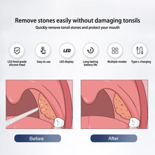 Load image into Gallery viewer, Electric Tonsil Stone Remover Tonsil Stone Removal Kit Vacuum With Irrigation Syringe Instant Suction Tonsil Stone Removal
