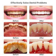 Load image into Gallery viewer, Ultrasonic Dental Tartar Cleaner Electric Tooth Polisher Tartar Eliminator Teeth Whitening Dental Calculus Plaque Tartar Remover
